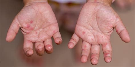 hfm twitter|About Hand, Foot, and Mouth Disease.